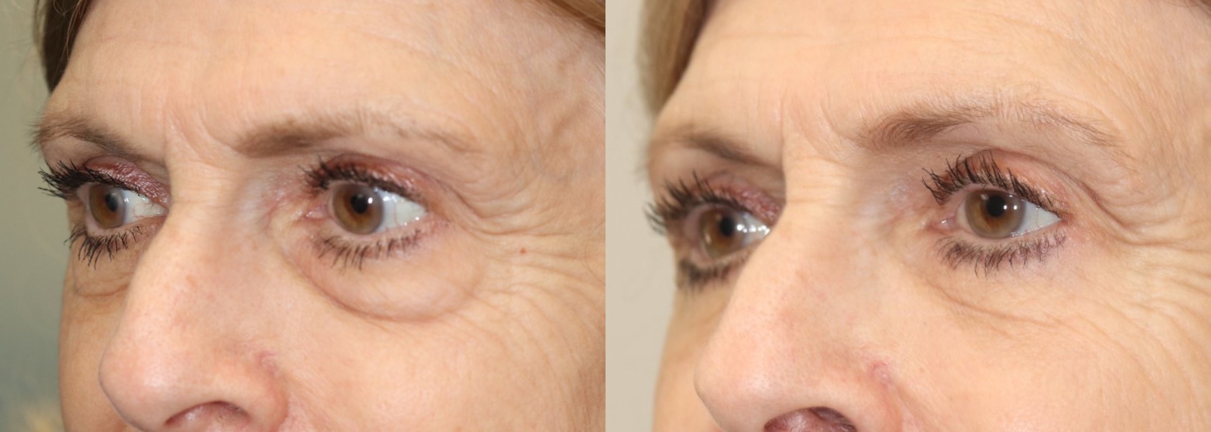 Before and After Image: Lower Blepharoplasty - left-front-oblique