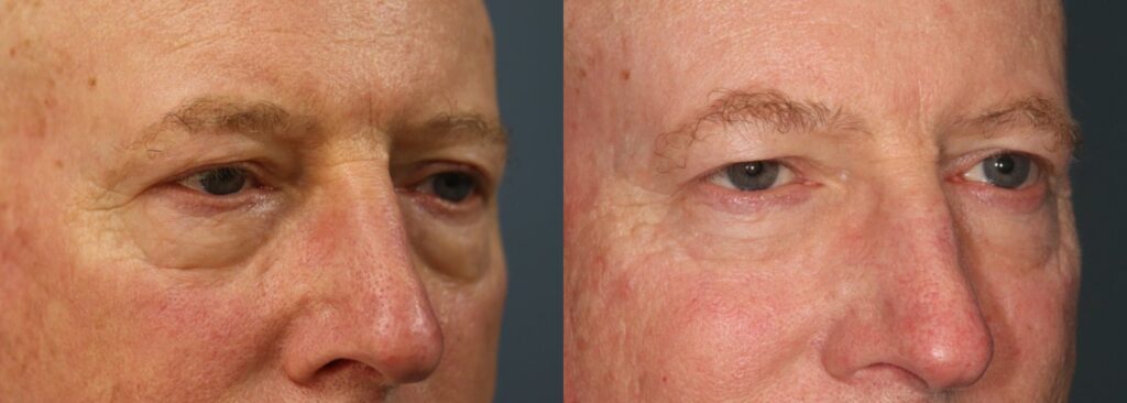 Before and After Image: Lower Blepharoplasty - right-front-oblique