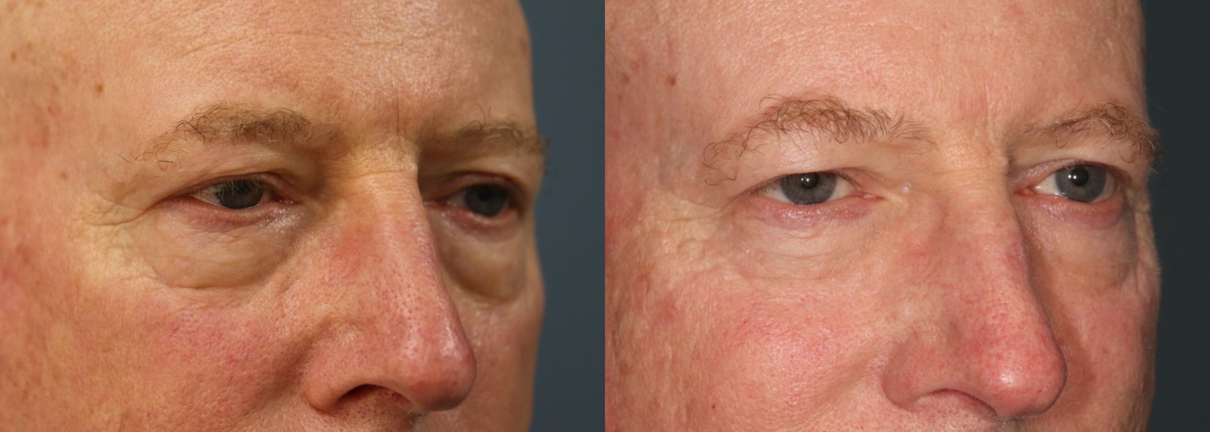 Before and After Image: Lower Blepharoplasty - right-front-oblique