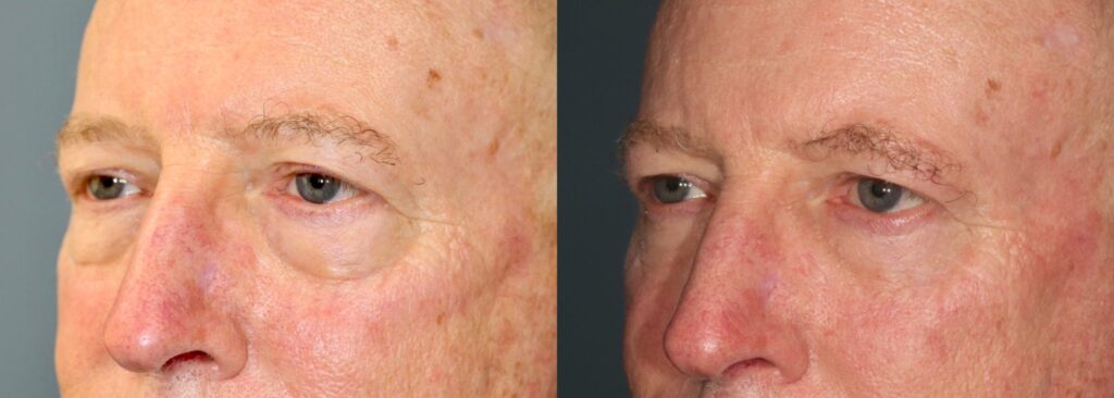 Before and After Image: Lower Blepharoplasty - left-front-oblique