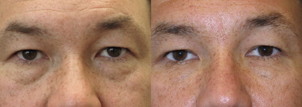 Before and After Image: Lower Blepharoplasty - front