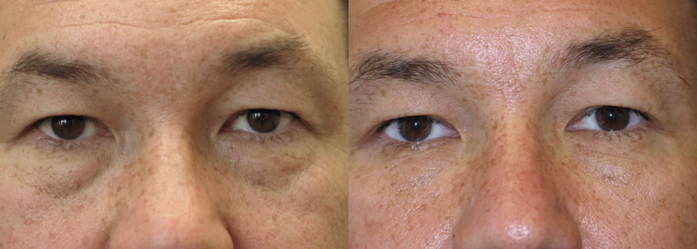 Before and After Image: Lower Blepharoplasty - front