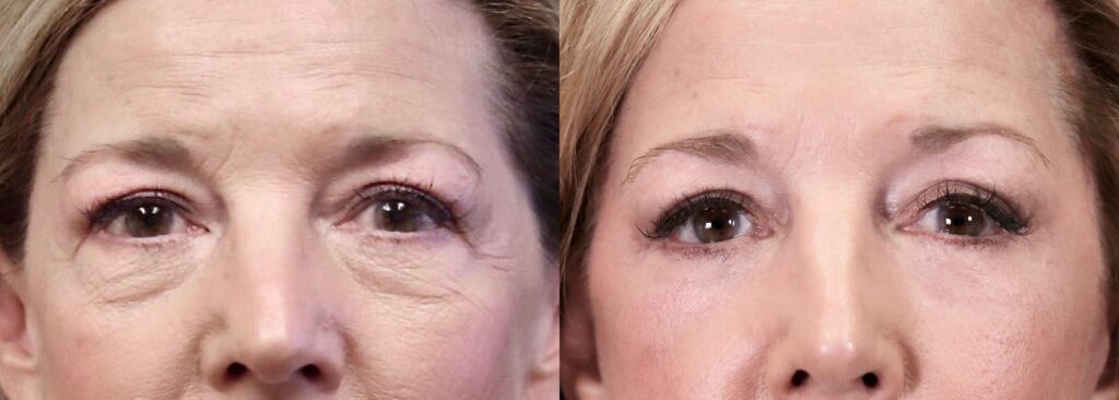 Before and After Image: Lower Blepharoplasty - front