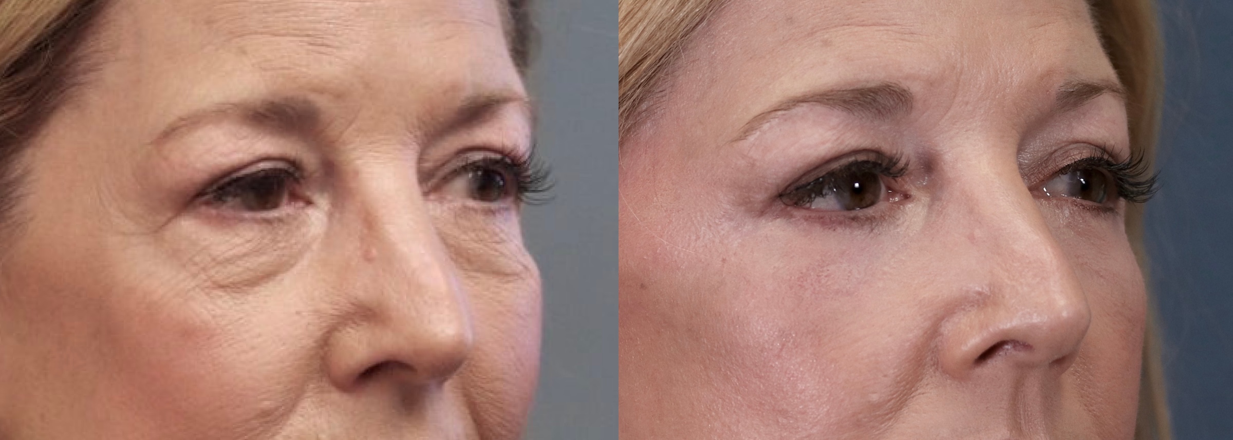 Before and After Image: Lower Blepharoplasty - right-front-oblique