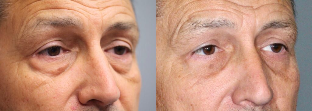 Before and After Image: Lower Blepharoplasty - right-front-oblique