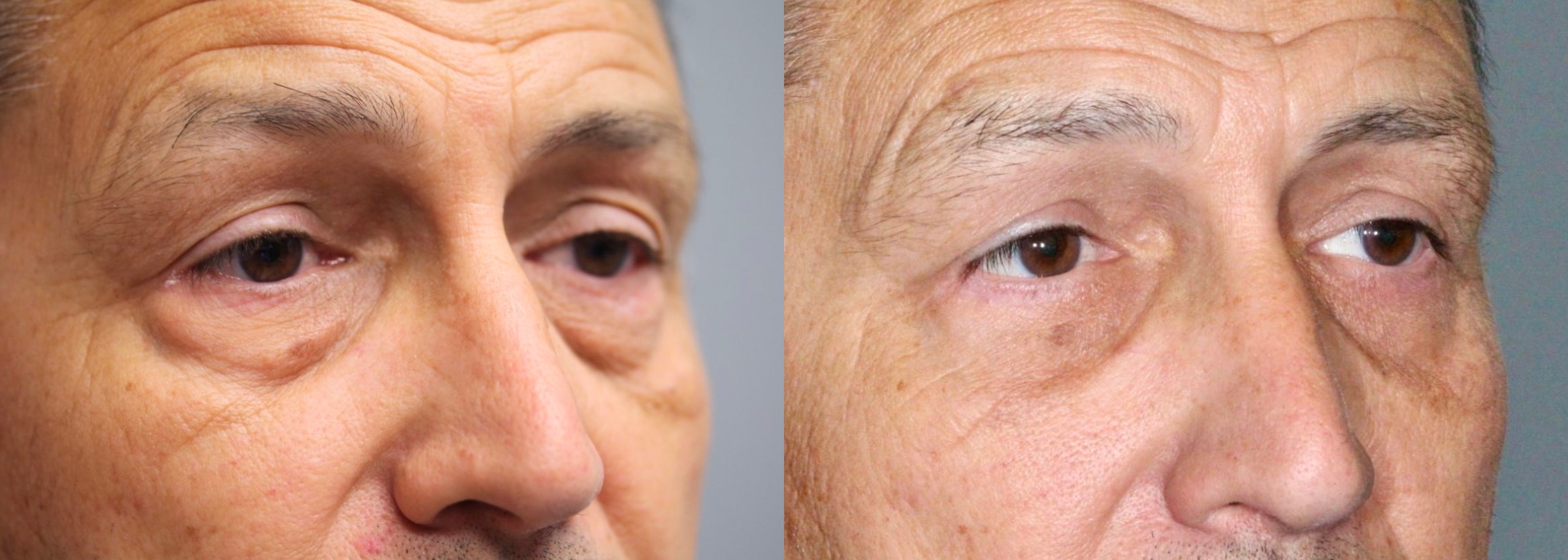 Before and After Image: Lower Blepharoplasty - right-front-oblique
