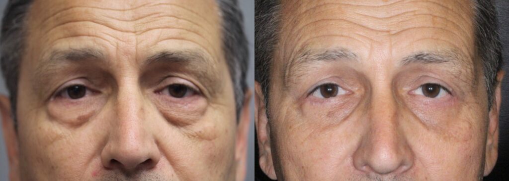 Before and After Image: Lower Blepharoplasty - front