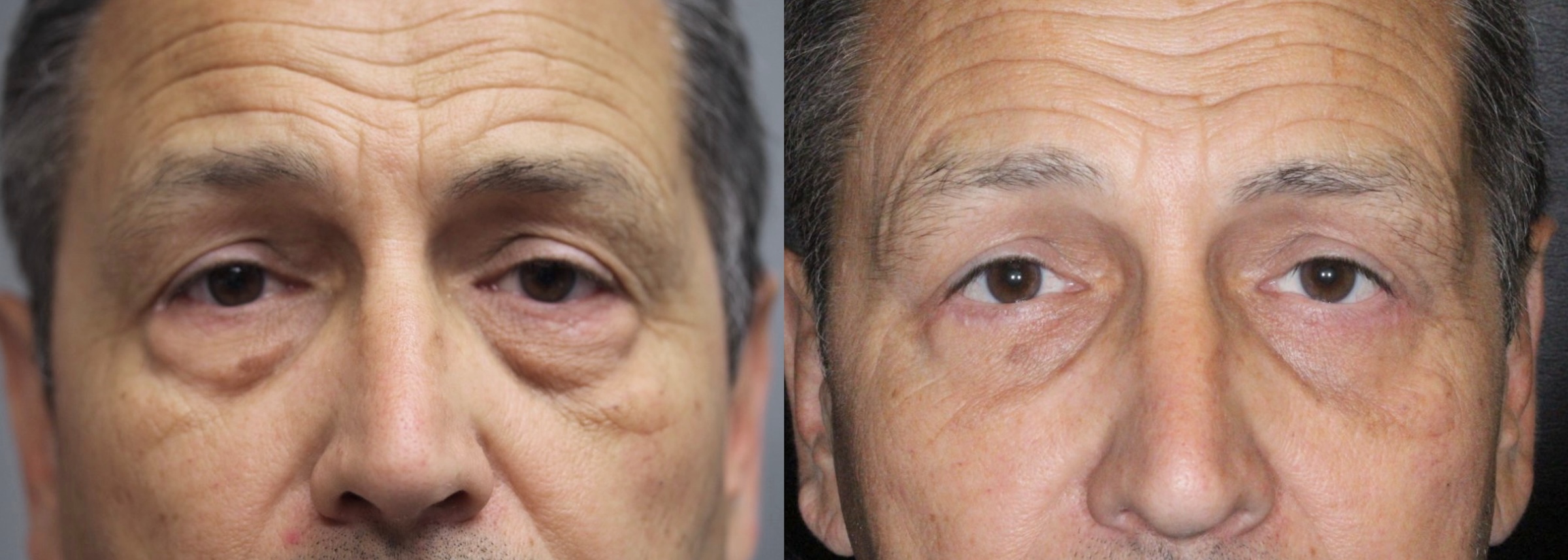 Before and After Image: Lower Blepharoplasty - front