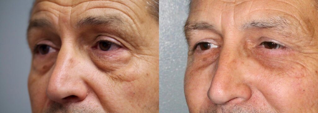Before and After Image: Lower Blepharoplasty - left-front-oblique