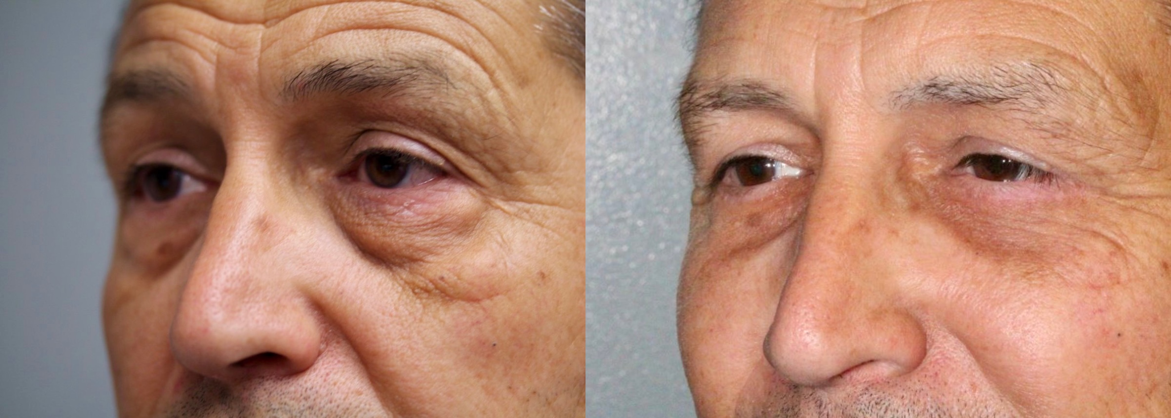 Before and After Image: Lower Blepharoplasty - left-front-oblique