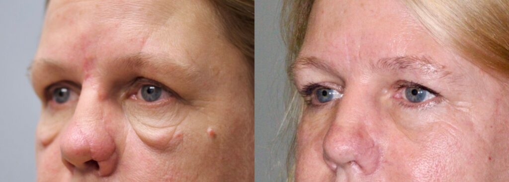Before and After Image: Lower Blepharoplasty - left-front-oblique