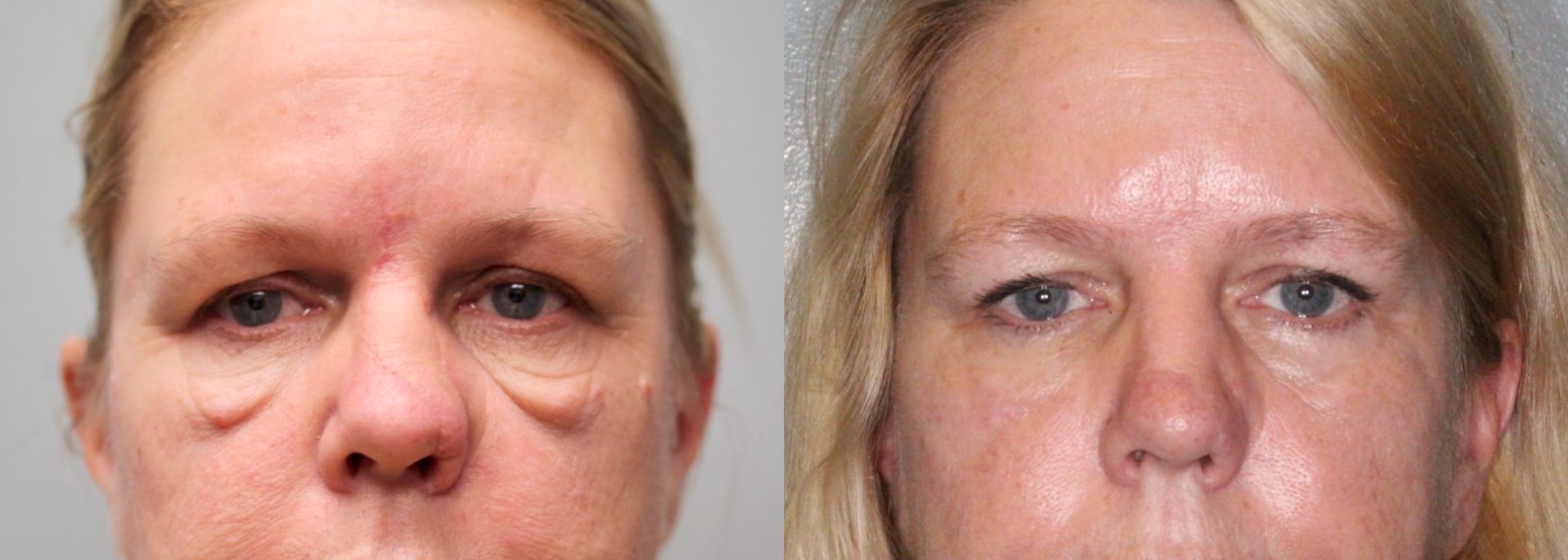 Before and After Image: Lower Blepharoplasty - front