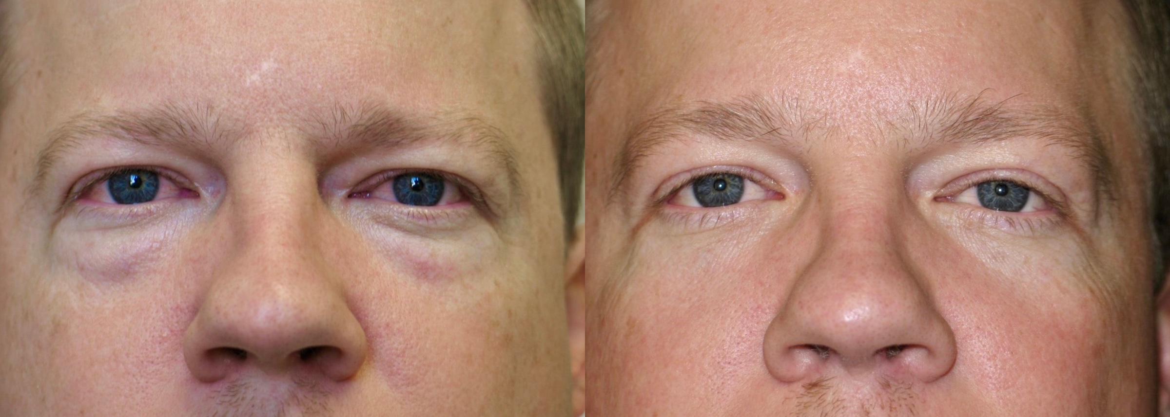 Before and After Image: Lower Blepharoplasty - front