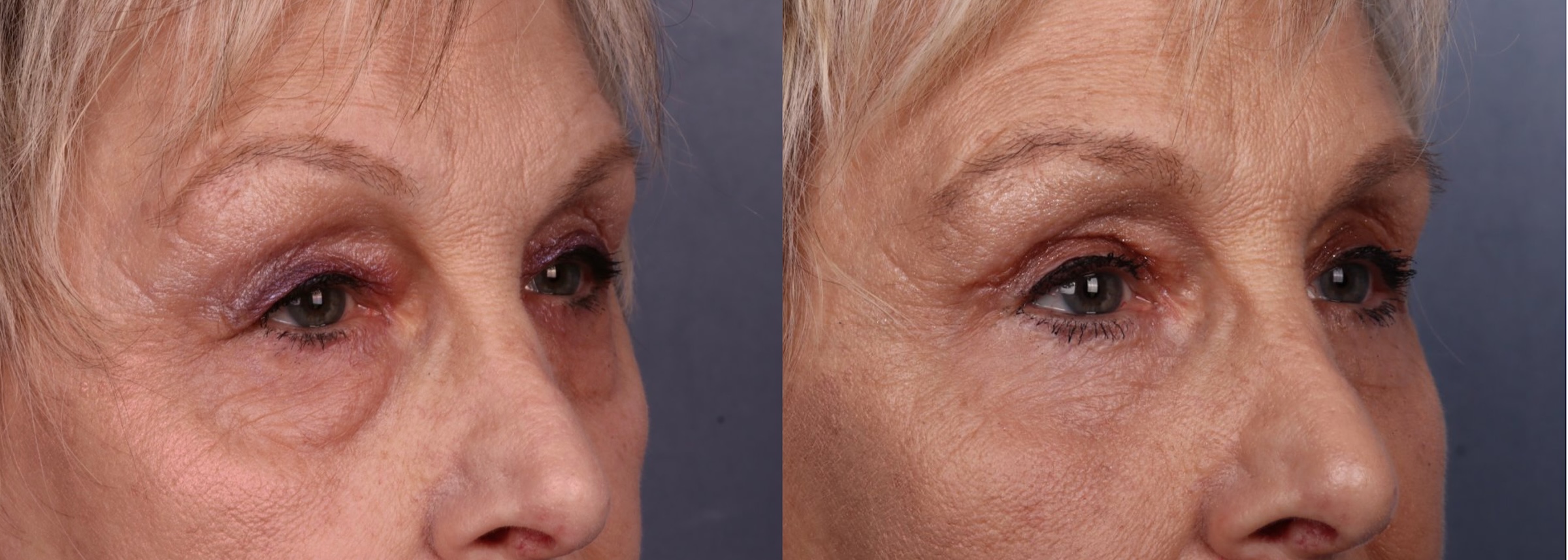 Before and After Image: Upper & Lower Blepharoplasty - right-front-oblique
