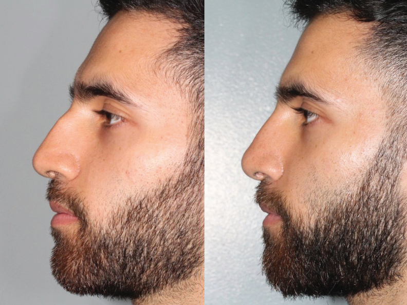 Before and After Image: Rhinoplasty - left-side