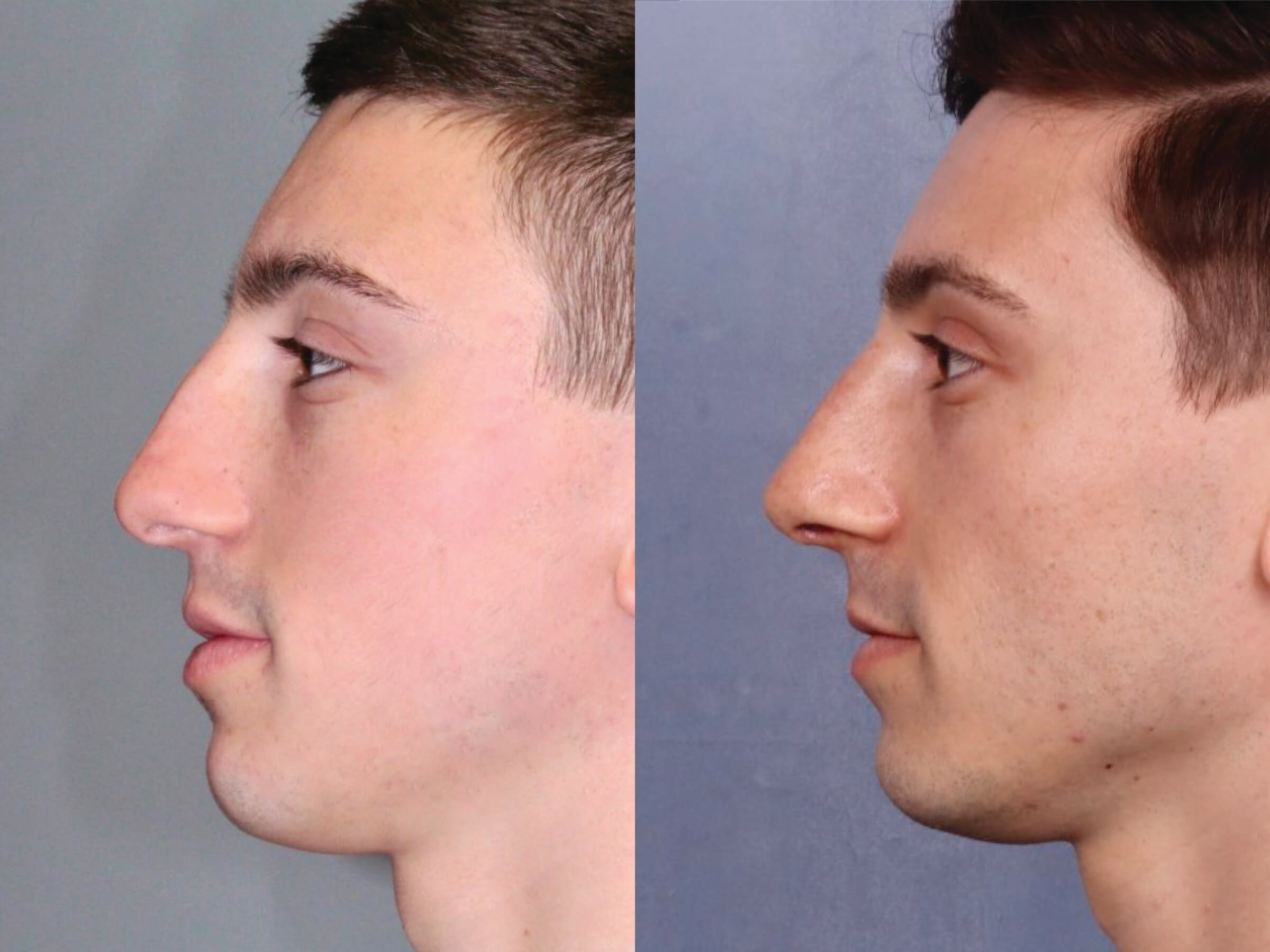 Before and After Image: Rhinoplasty - left-side