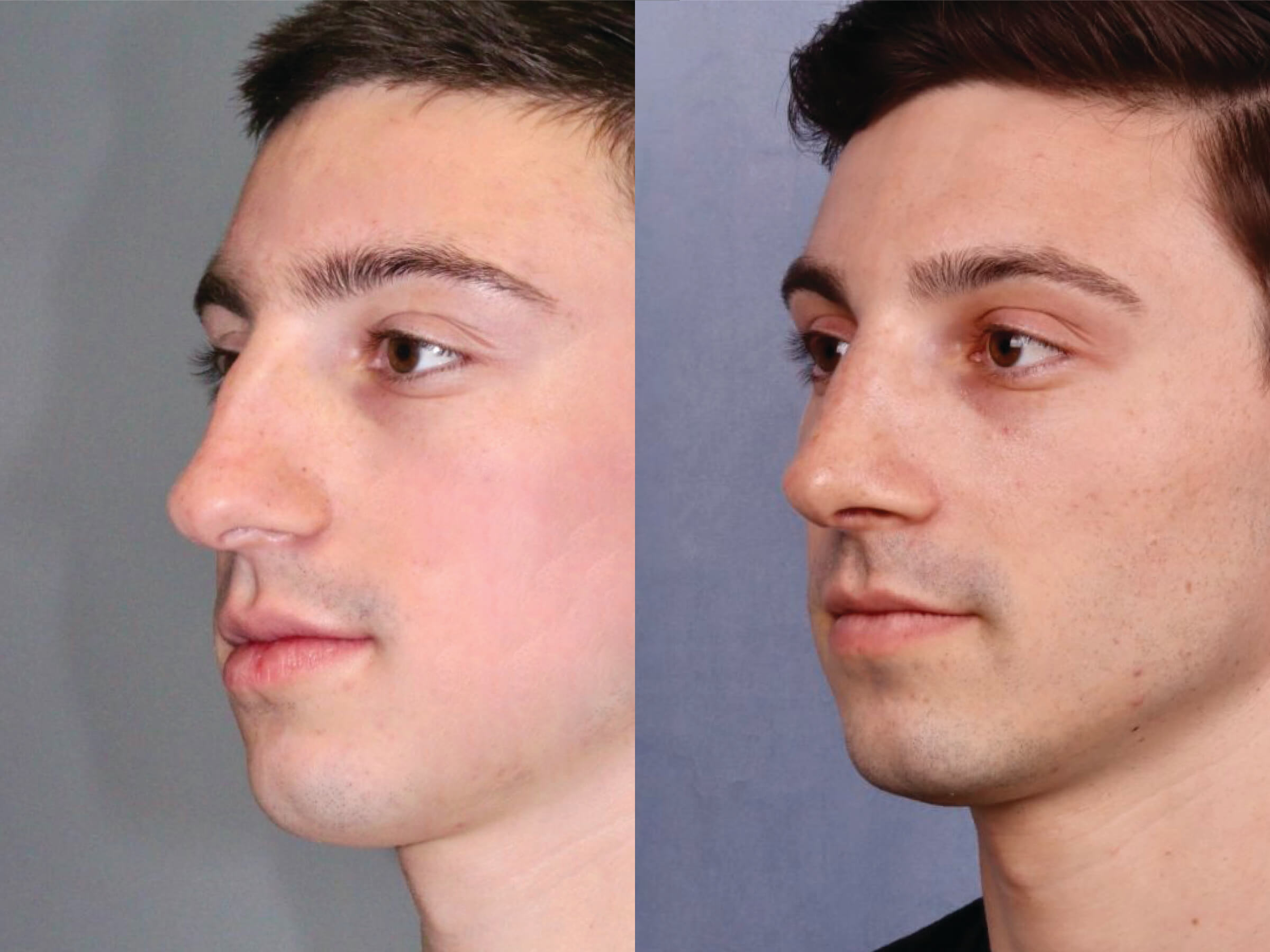 Before and After Image: Rhinoplasty - left-front-oblique
