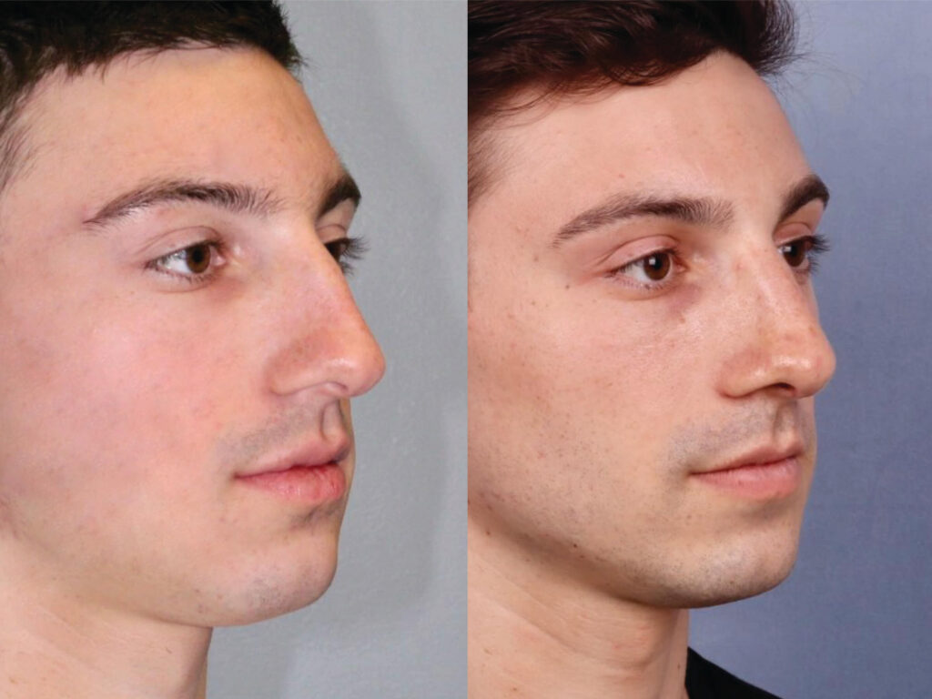 Before and After Image: Rhinoplasty - right-front-oblique
