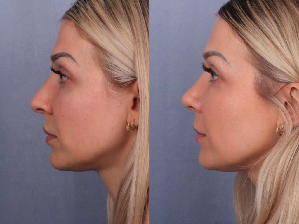 Before and After Image: Rhinoplasty - left-side