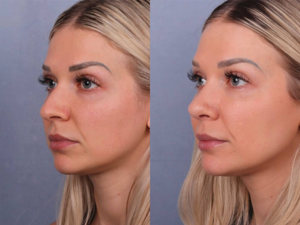Before and After Image: Rhinoplasty - left-front-oblique