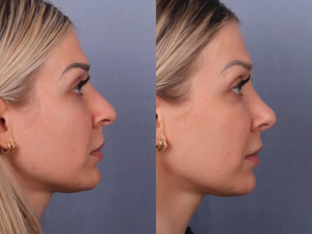 Before and After Image: Rhinoplasty - right-side