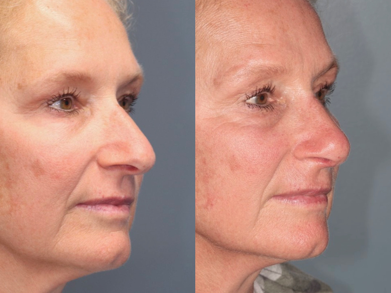 Before and After Image: Rhinoplasty - right-front-oblique