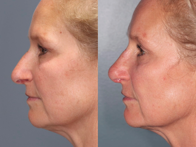Before and After Image: Rhinoplasty - left-side