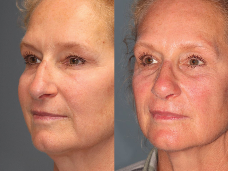 Before and After Image: Rhinoplasty - left-front-oblique