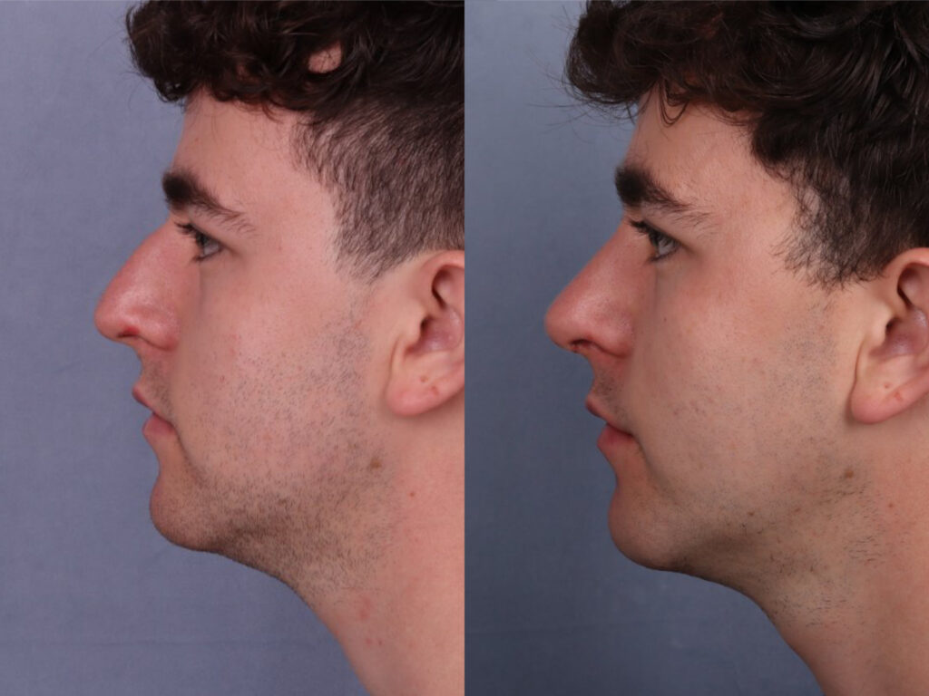 Before and After Image: Rhinoplasty - left-side