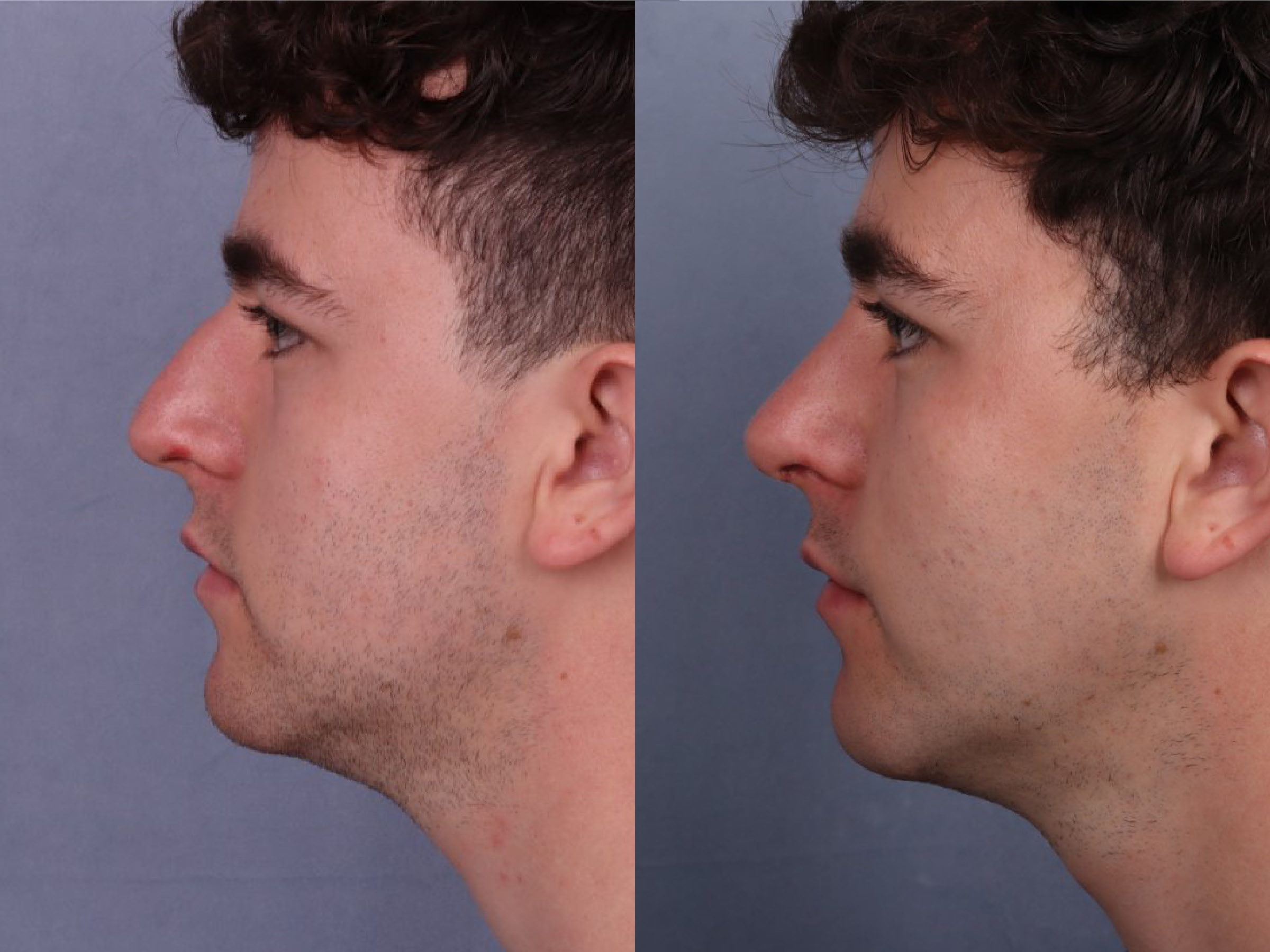 Before and After Image: Rhinoplasty - left-side