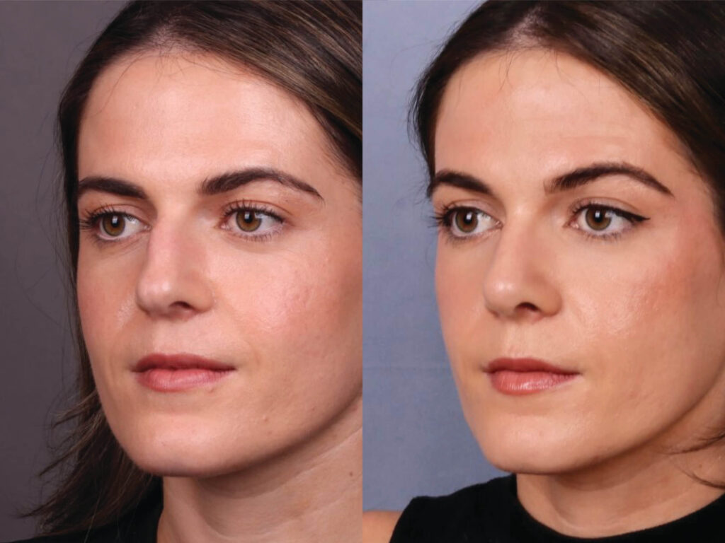 Before and After Image: Rhinoplasty - left-front-oblique