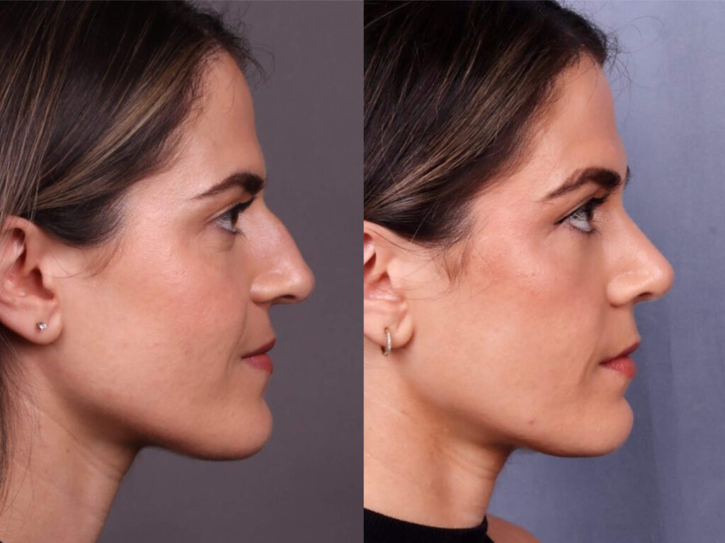 Before and After Image: Rhinoplasty - right-side