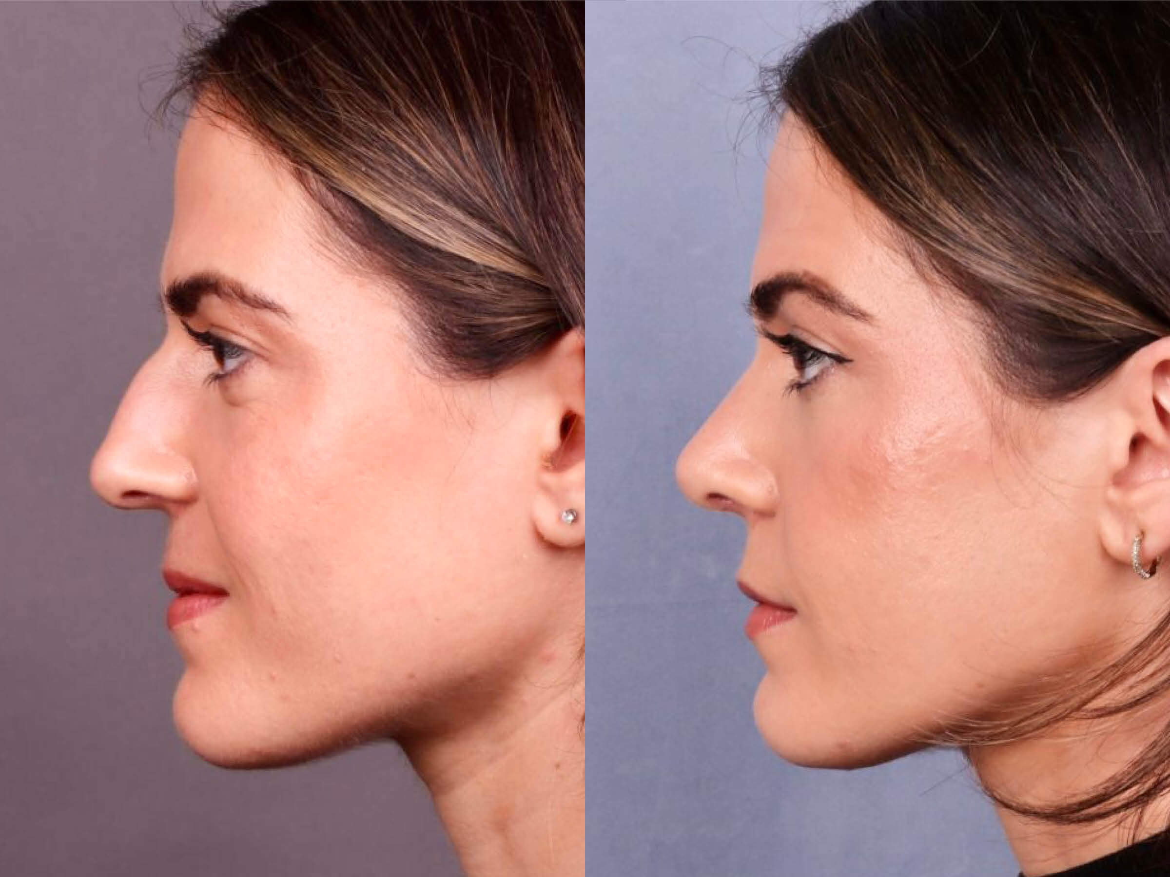 Before and After Image: Rhinoplasty - left-side