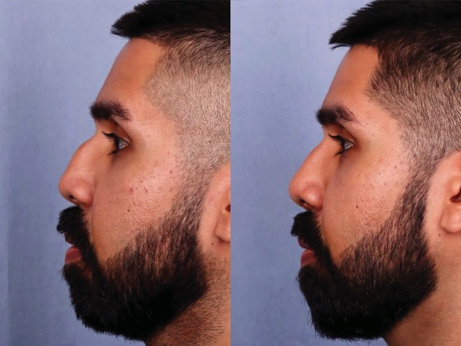 Before and After Image: Rhinoplasty - left-side