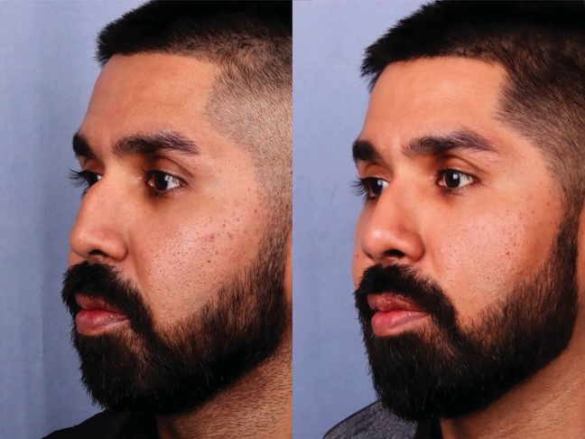 Before and After Image: Rhinoplasty - left-front-oblique