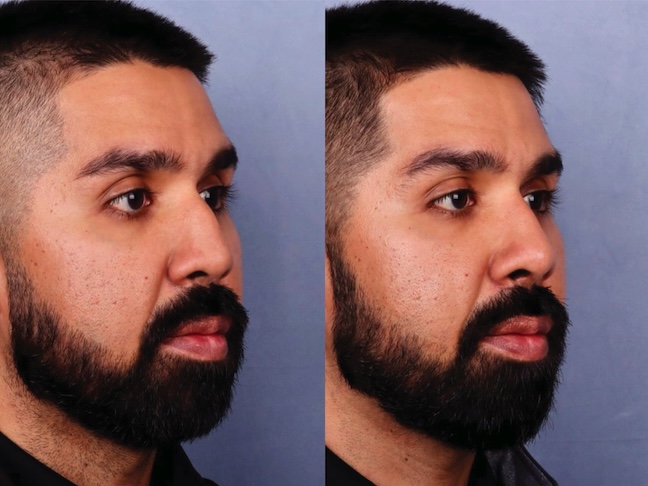 Before and After Image: Rhinoplasty - right-front-oblique