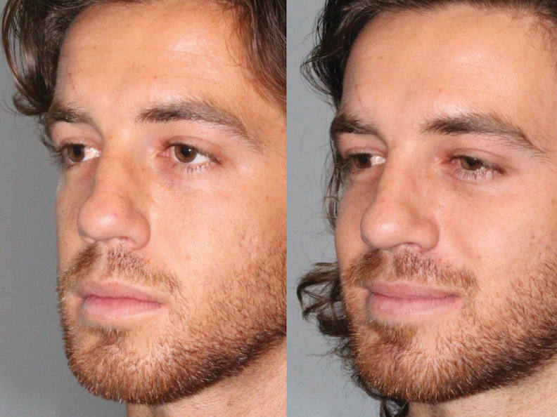 Before and After Image: Rhinoplasty - left-front-oblique