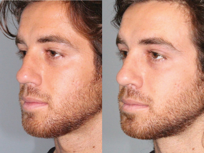 Before and After Image: Rhinoplasty - left-front-oblique