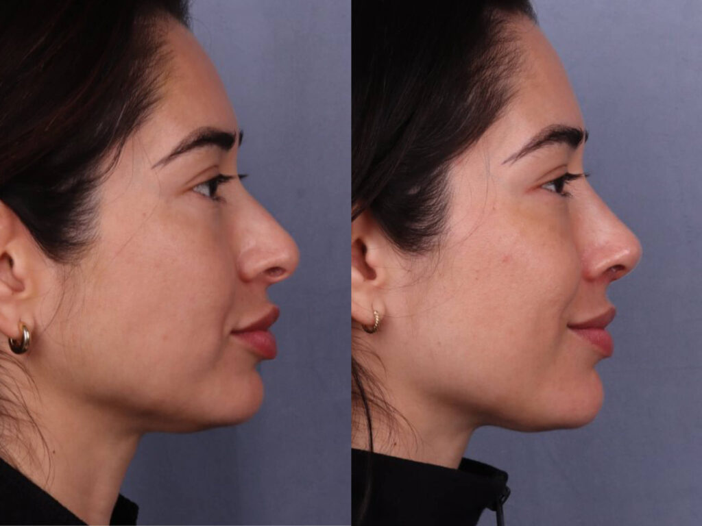 Before and After Image: Rhinoplasty - right-side
