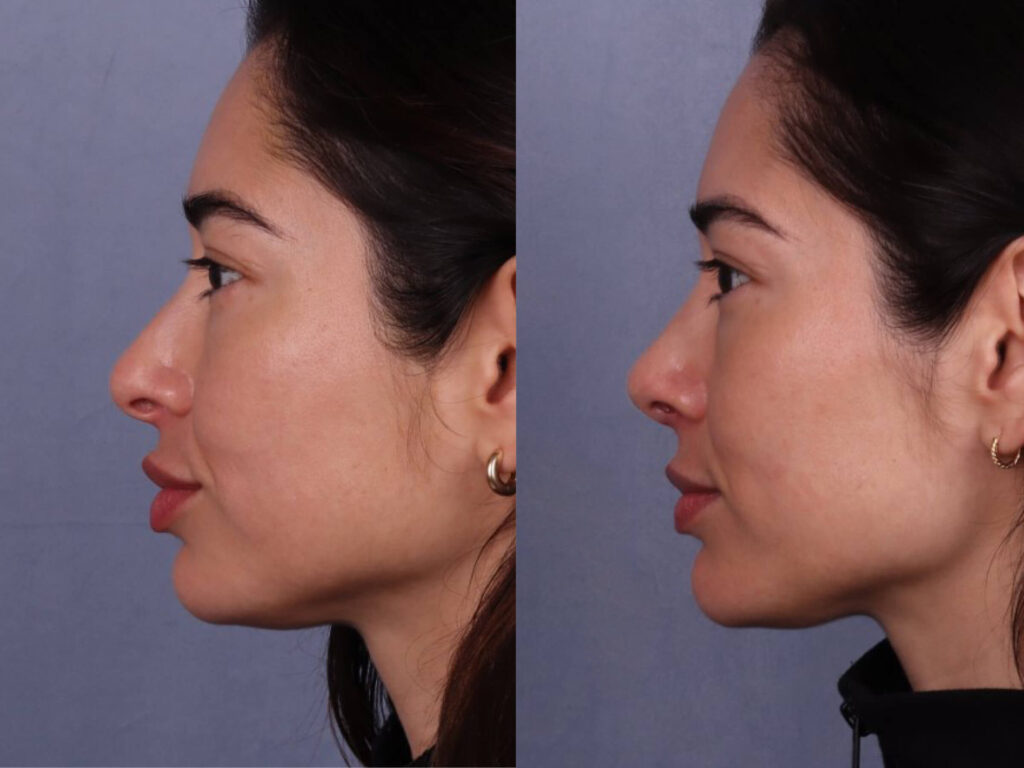 Before and After Image: Rhinoplasty - left-side