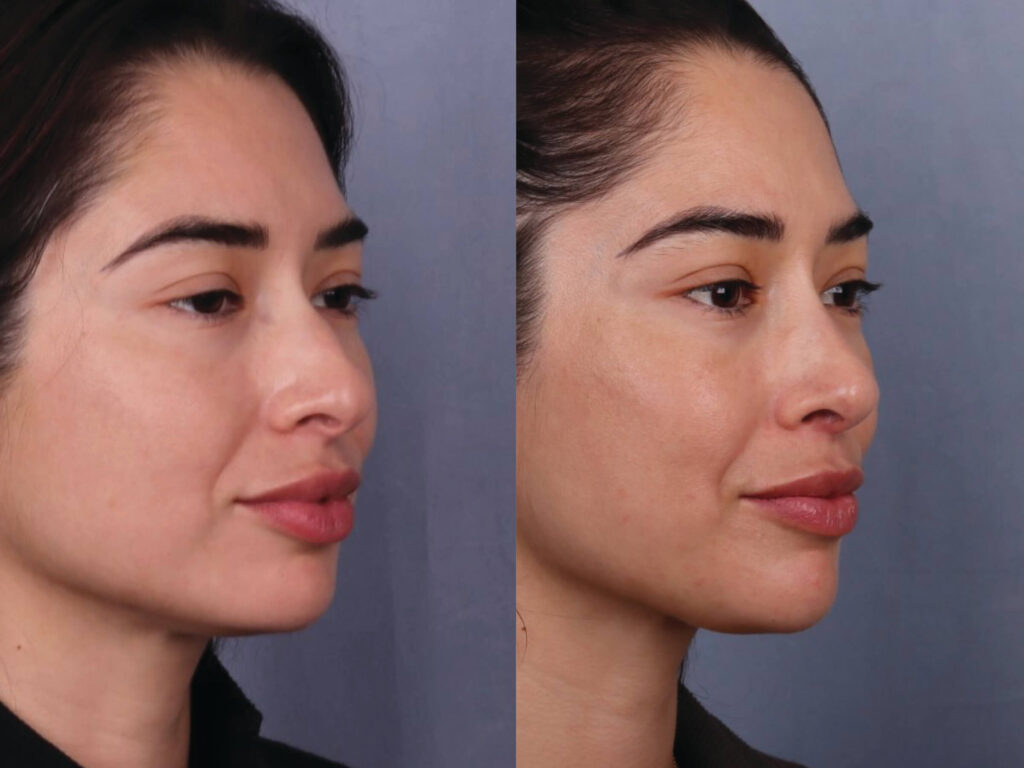 Before and After Image: Rhinoplasty - right-front-oblique