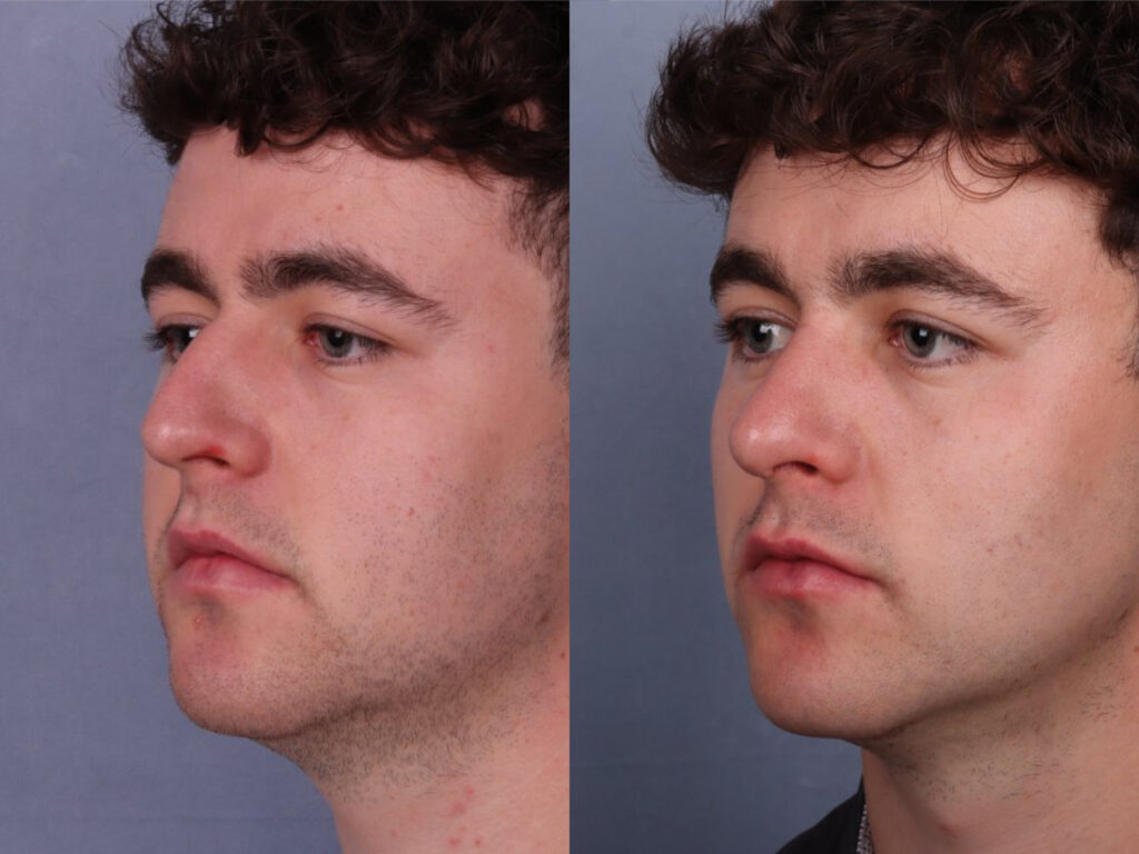 Before and After Image: Rhinoplasty - left-front-oblique