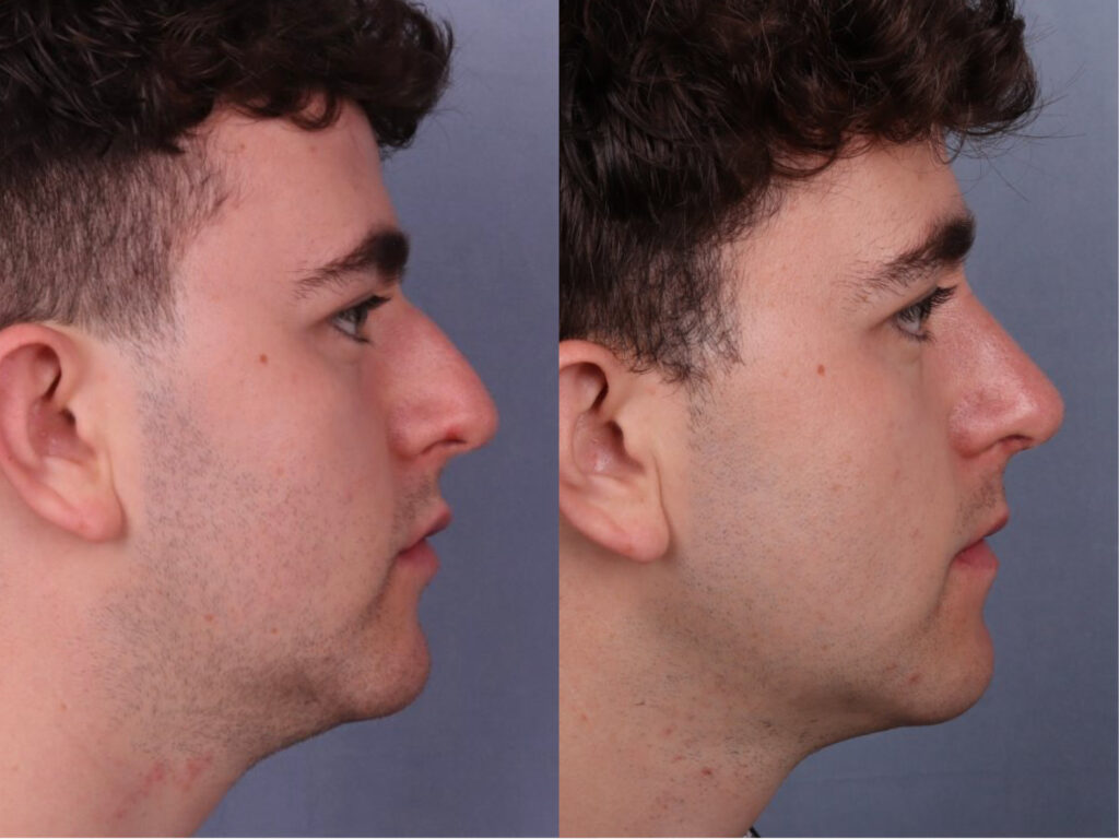 Before and After Image: Rhinoplasty - right-side