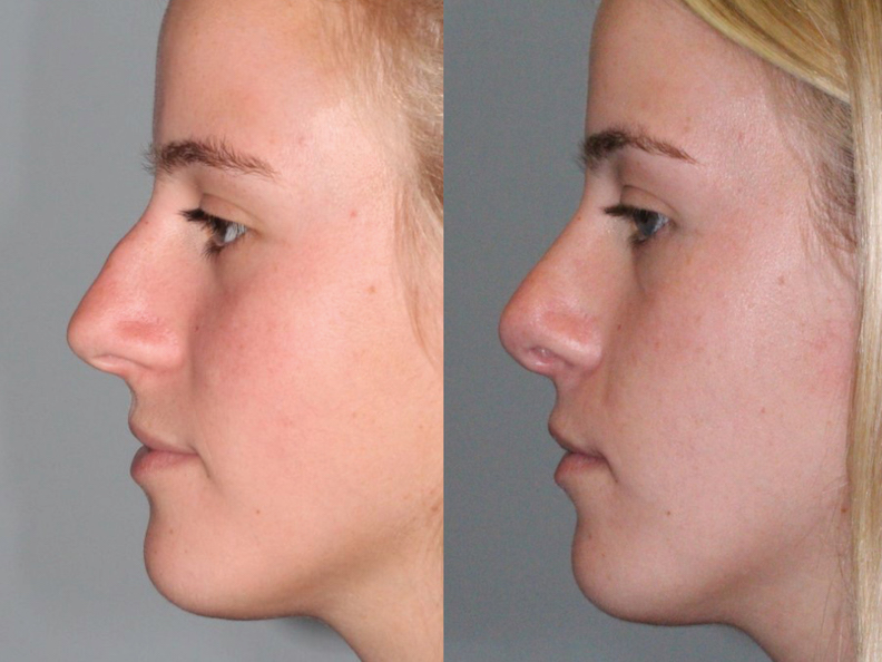Before and After Image: Rhinoplasty - left-side