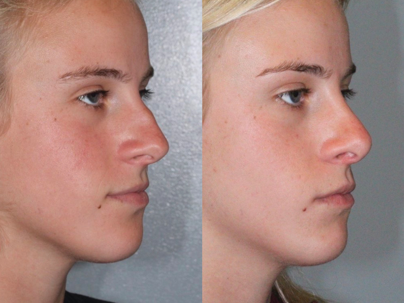 Before and After Image: Rhinoplasty - right-front-oblique