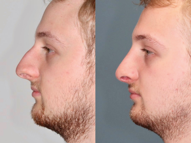 Before and After Image: Rhinoplasty - left-side