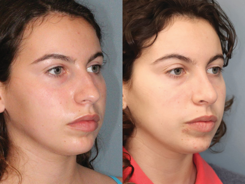 Before and After Image: Rhinoplasty - right-front-oblique