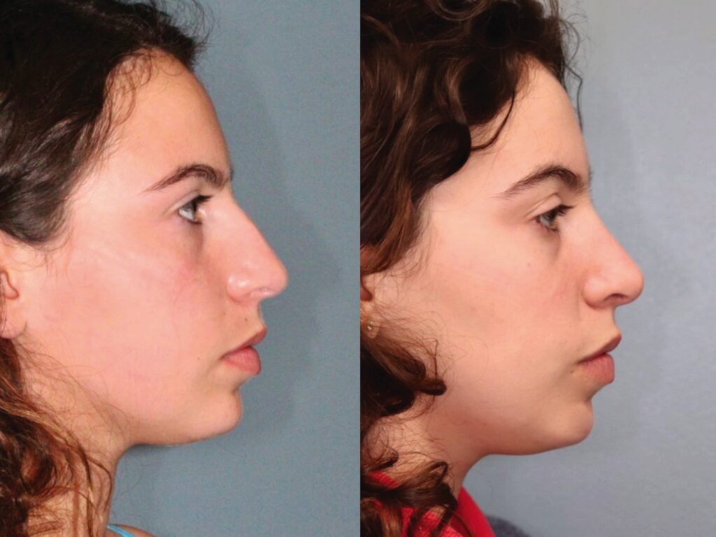 Before and After Image: Rhinoplasty - right-side