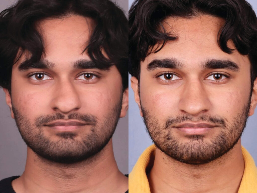 Before and After Image: Rhinoplasty - front