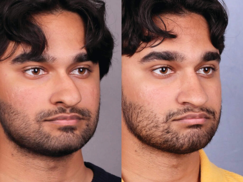 Before and After Image: Rhinoplasty - right-front-oblique
